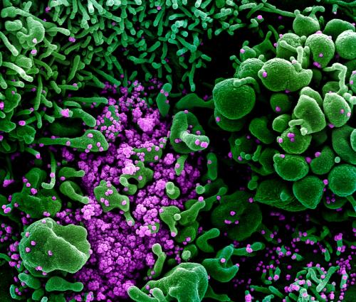 Colourised scanning electron micrograph of a cell heavily infected with SARS-CoV-2 virus particles